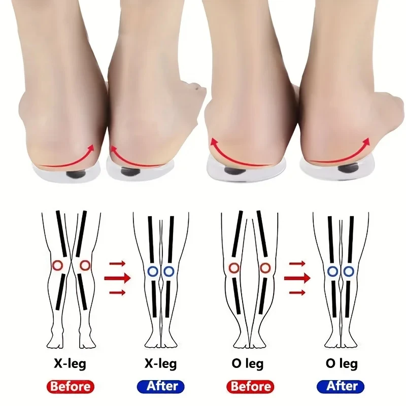 Women Shoes Types - แผ่นรองรองเท้าสำหรับนวดกระดูกและข้อ1คู่สำหรับขา O/X การแก้ไข valgus ซิลิโคนเจลพื้นรองเท้าแม่เหล็กสำหรับผู้ชายผู้หญิง